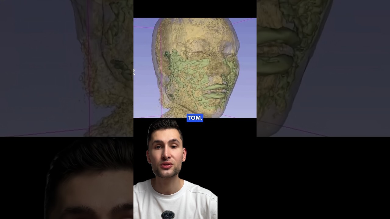 отек лица от филлеров — Филлеры = отек лица