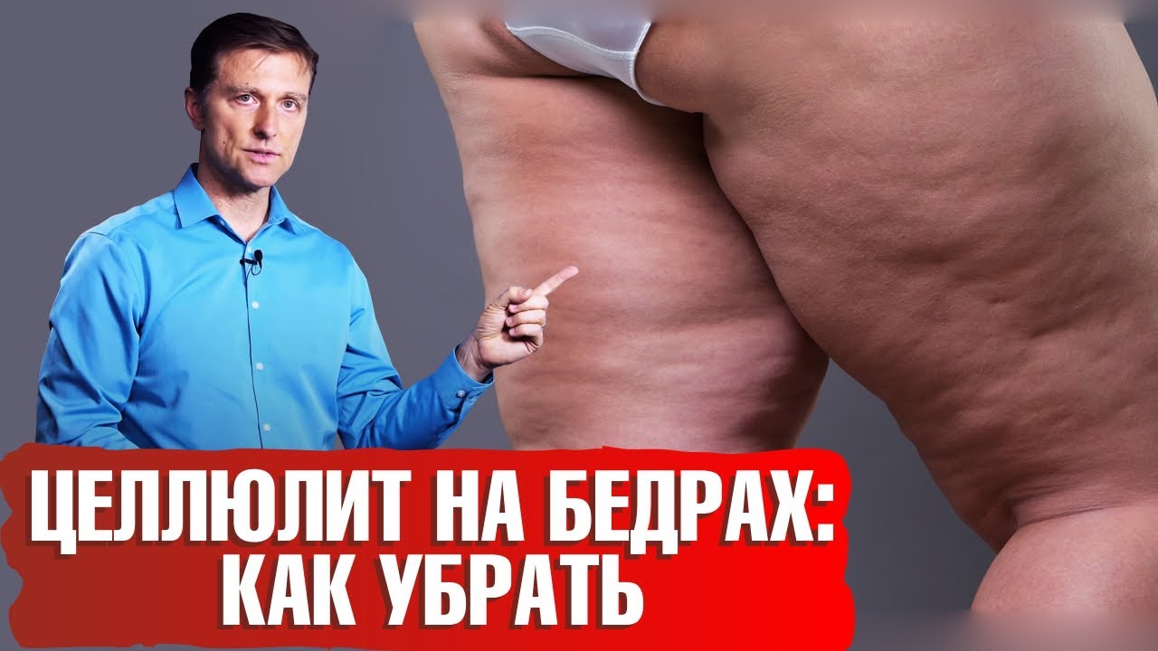 целлюлит на бедрах — Как избавиться от целлюлита на бедрах? Почему появляется целлюлит? 📣