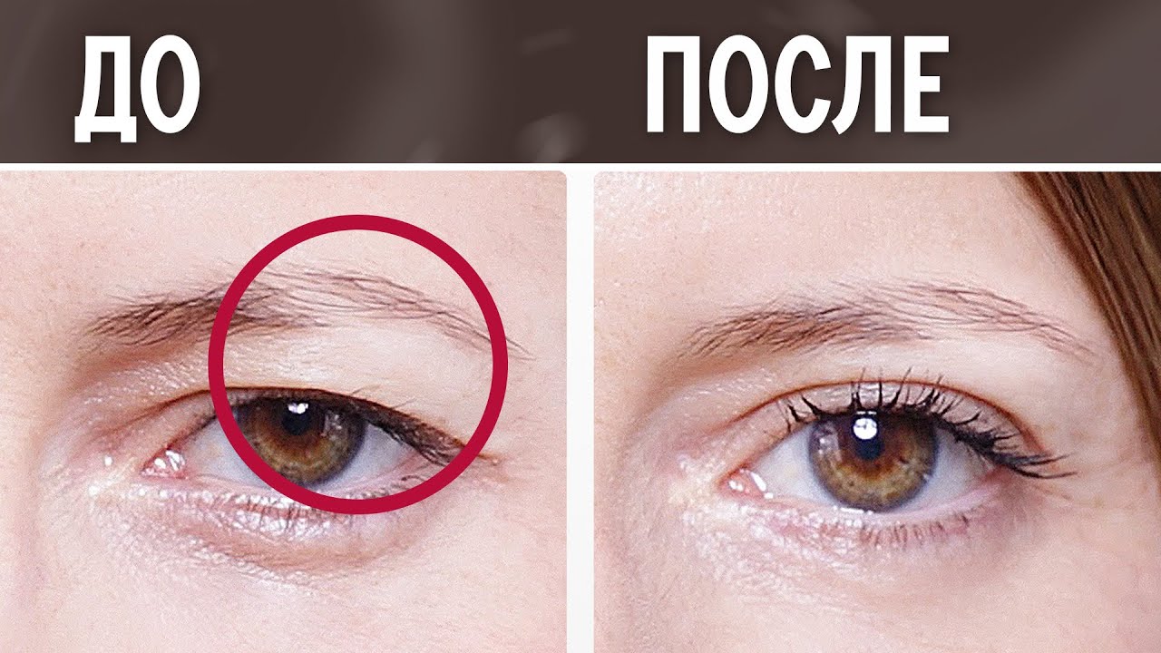 как убрать нависшее веко — Как убрать НАВИСШЕЕ ВЕКО за 5 минут | ИТОГИ конкурса (16+)