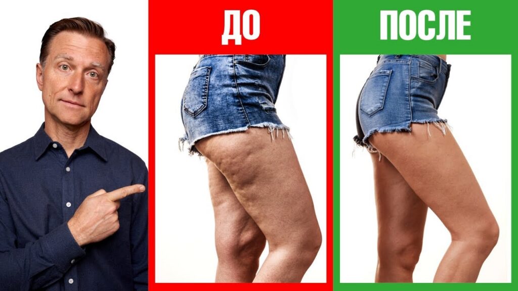 Избавиться от целлюлита — Лучший способ избавиться от целлюлита🔥💃