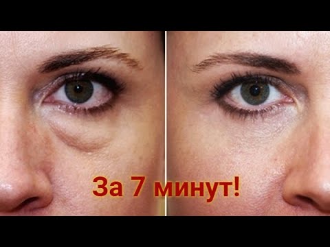 как убрать отеки под глазами — МЕШКИ и ОТЕКИ под глазами. Как убрать отеки под глазами? Рецепт. Малярные мешки и отеки. #2.