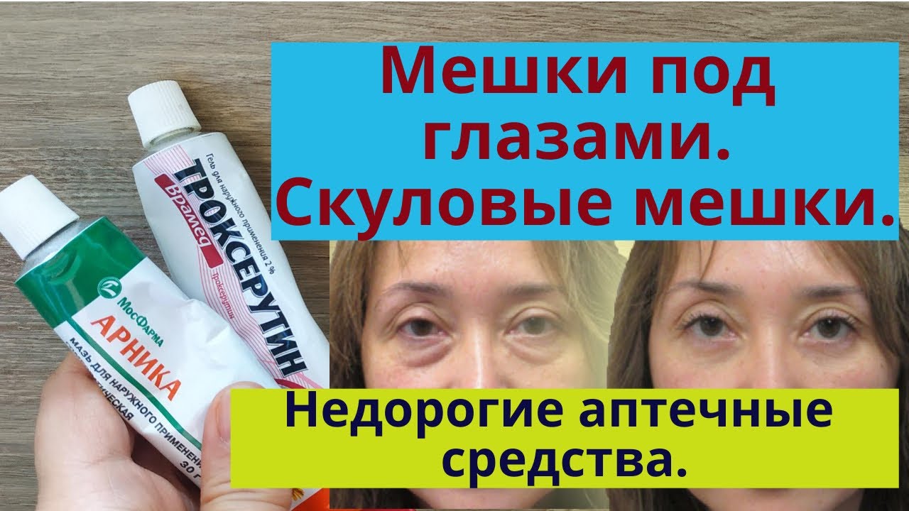 Бюджетные средства от мешков — Мешки под глазами, малярные мешки, отеки глаз. Бюджетные аптечные средства от мешков под глазами.
