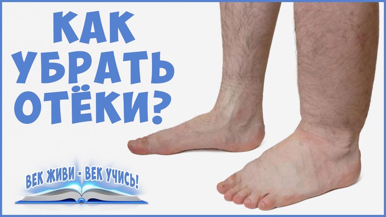 причины отеков — ОТЁКИ. Причины отёков. Как убрать отёки. Задержка Воды. Фролов Ю. А . Часть 1.