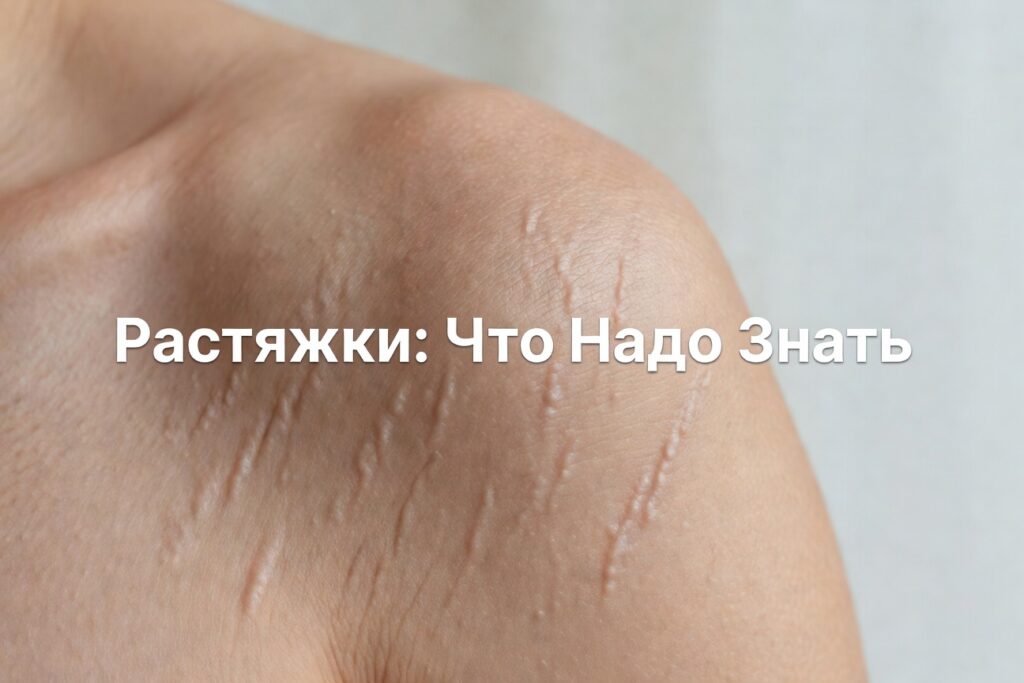 растяжки что знать — Растяжки (стрии). Что надо знать и как не натворить глупостей?